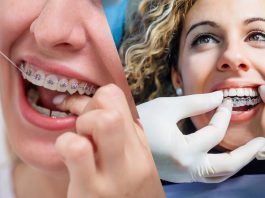 Is Invisalign i7 More Affordable Than Traditional Invisalign? Invisalign i7