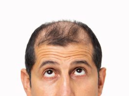 hair loss